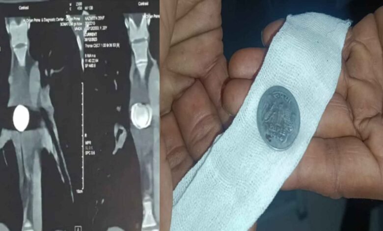 12 साल बाद पता चला गले में फंसा है 1 रुपए का सिक्का सोनोग्राफी से हुआ खुलासा
