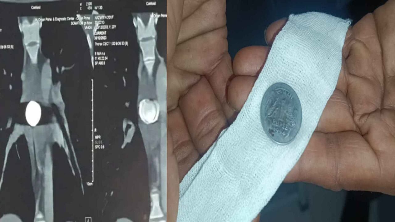 12 साल बाद पता चला गले में फंसा है 1 रुपए का सिक्का सोनोग्राफी से हुआ खुलासा